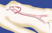 cardiac catheter diagram